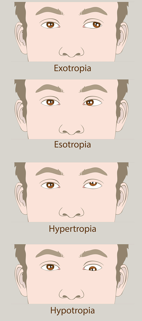 Amblyopia Corpus Christi