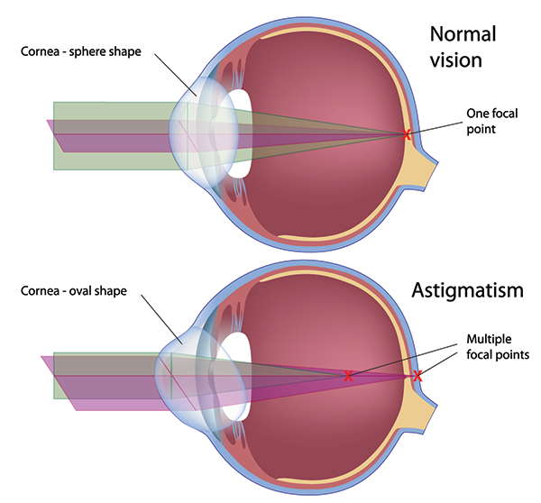 Astigmatism Corpus Christi