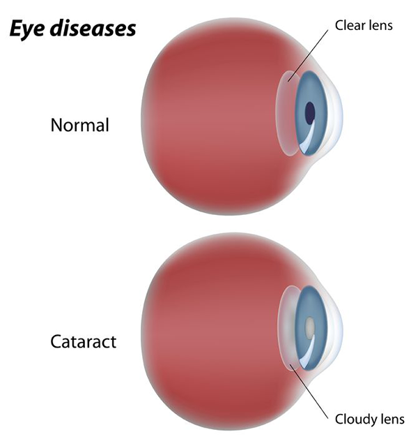 Cataract Surgery Aransas Pass