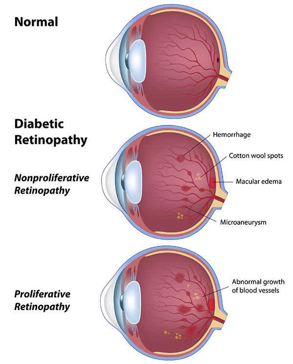 Diabetic Retinopathy Aransas Pass