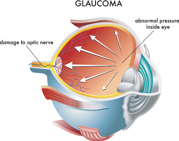 Glaucoma Treatment Aransas Pass