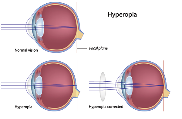 Corpus Christi Farsightedness