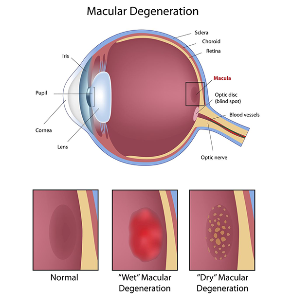 Macular Degeneration Corpus Christi