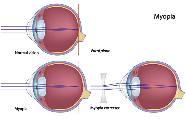 Corpus Christi Nearsightedness