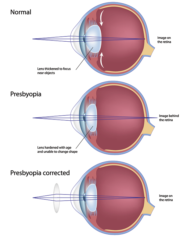 Presbyopia Corpus Christi